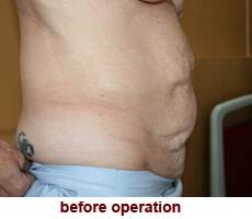 plastic-surgery-tummy-tuck
